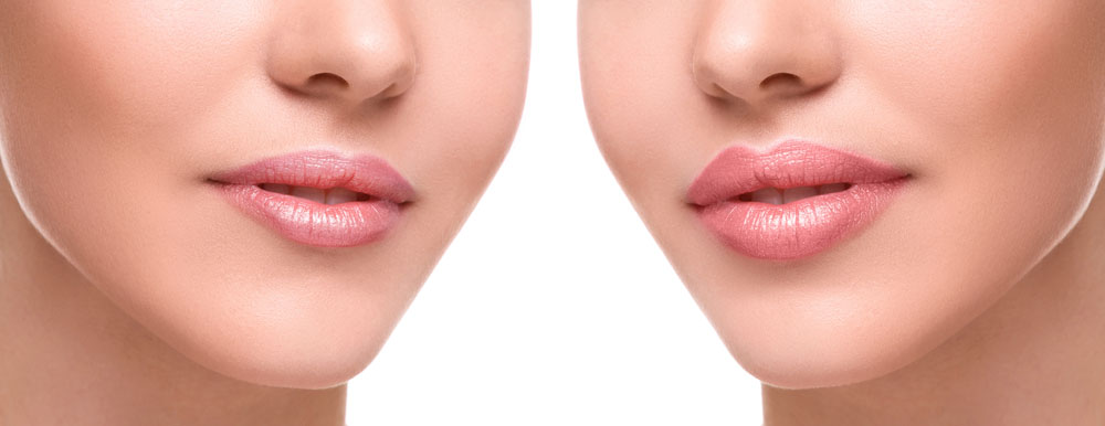 Lip Augmentation on Maui