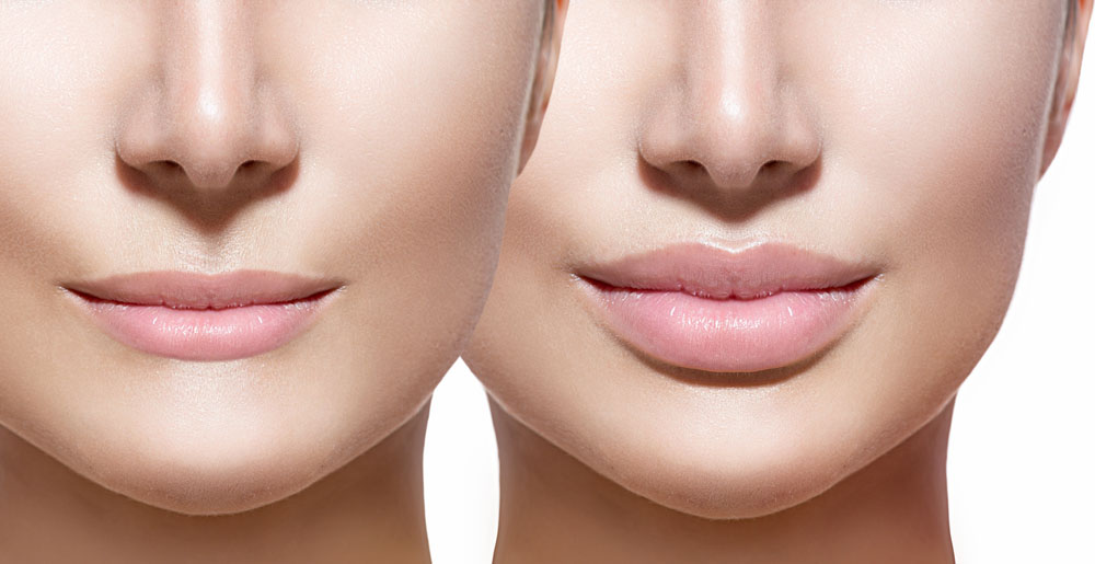 Get Plump Lips with Lip Injections