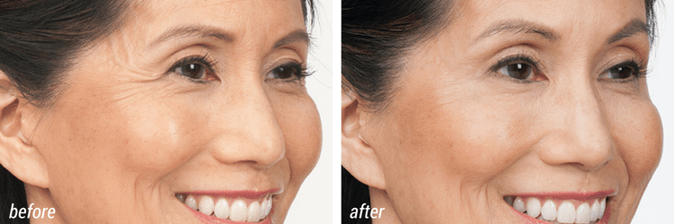 upper face cosmetic treatment