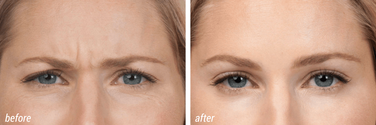 Botox treatment before and after