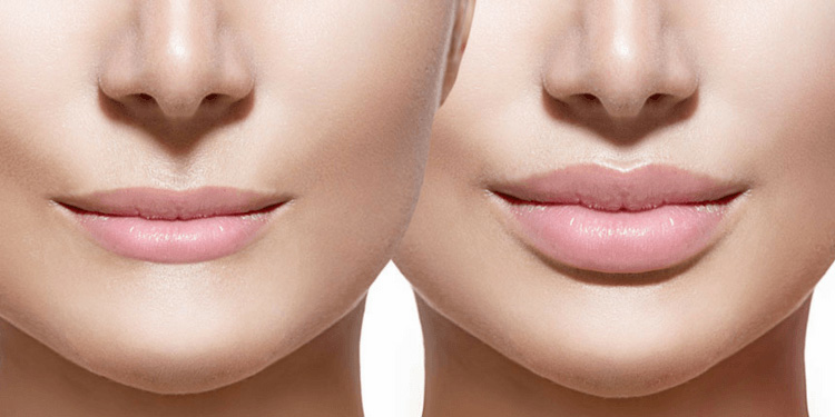 What Are The Risks of Dermal Fillers?