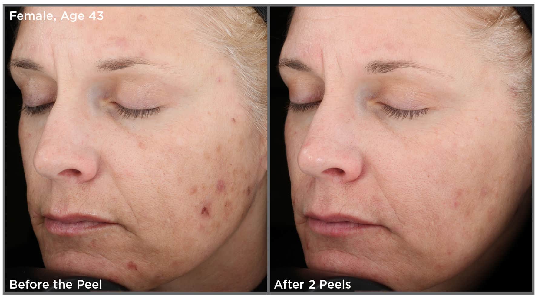 Vit Peel CS Female Age43 2 e1510702528316