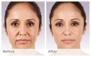 Juvederm XC