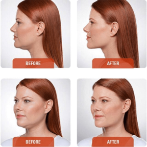 Kybella before and after - Woman