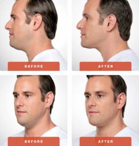 Kybella before and after - Man