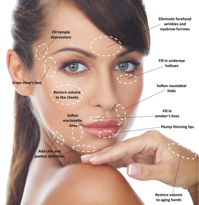 Dermal Filler Juvederm