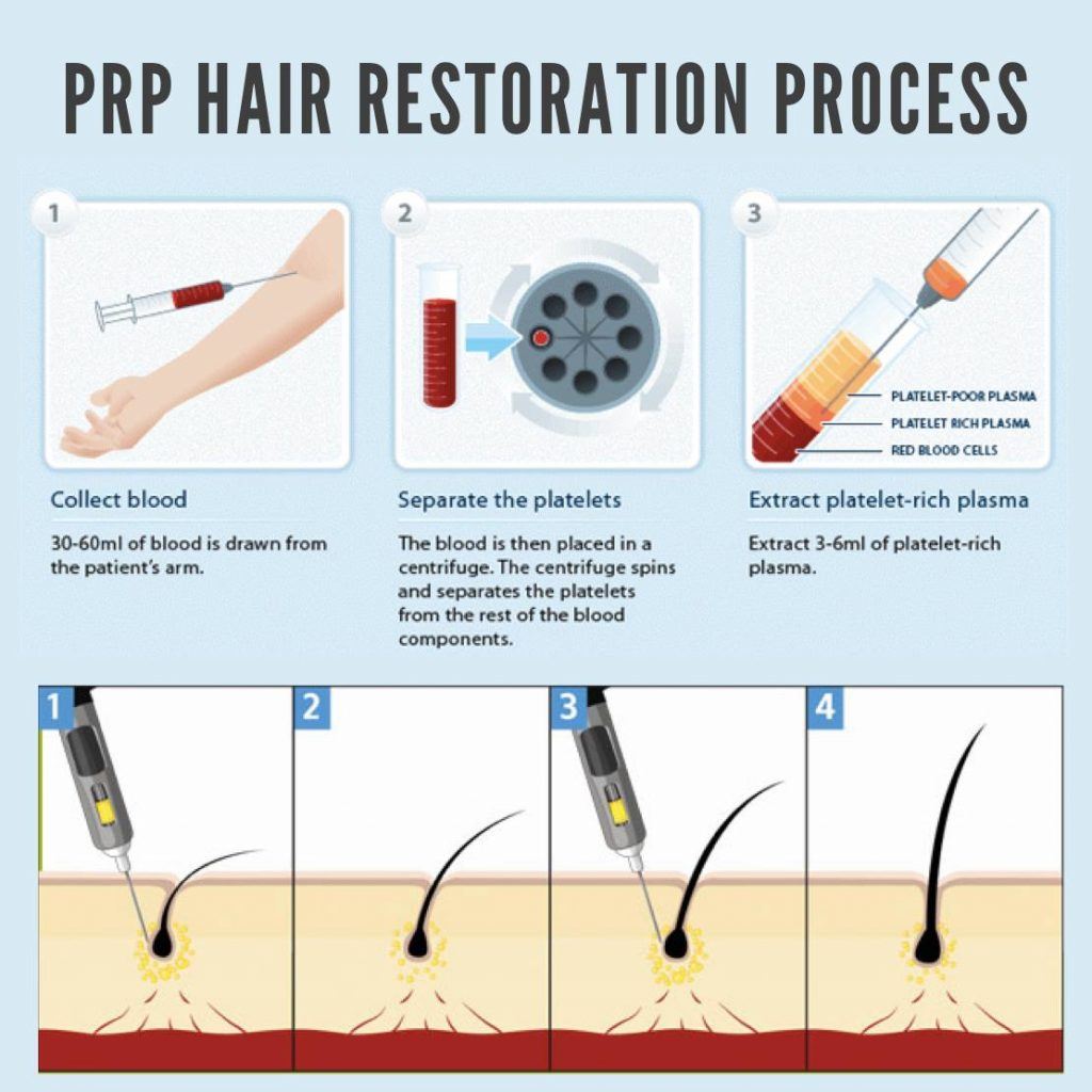 prp for hair loss