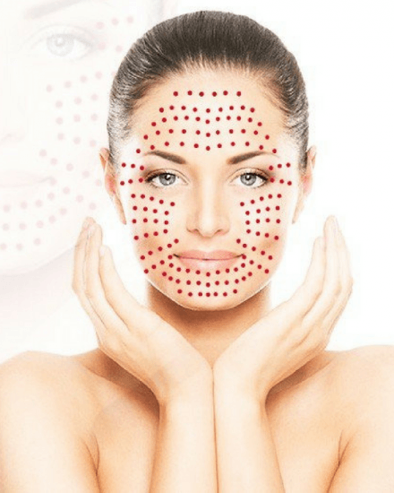 prp vampire facial