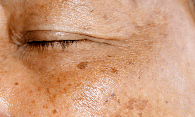 Anti-Hyperpigmentation Treatment