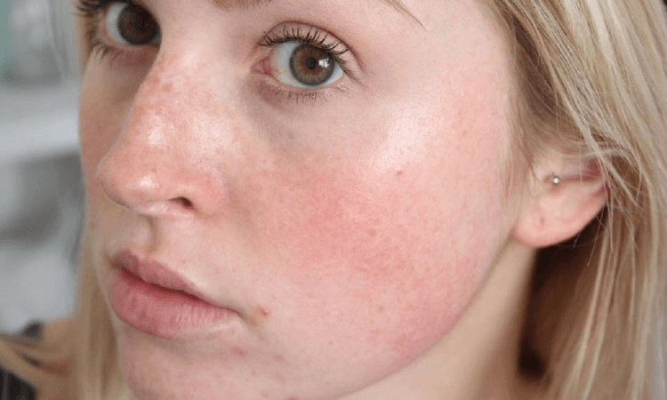 Redness/Rosacea Treatment