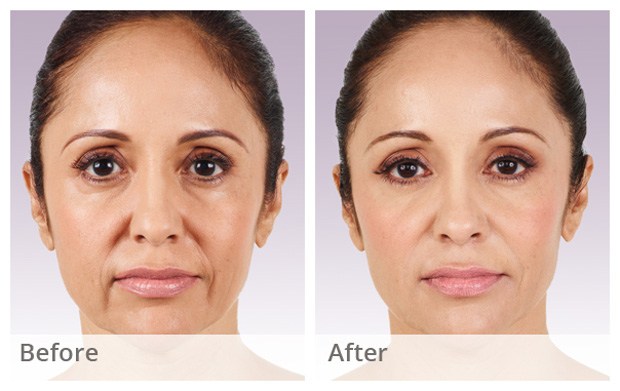 Juvederm Before and After