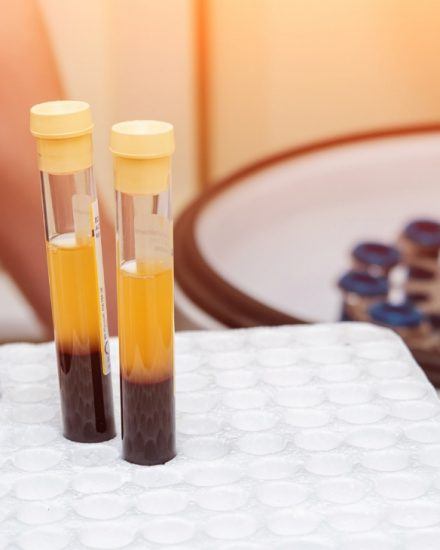 PLATELET RICH PLASMA FOR AESTHETICS