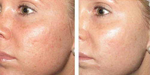 Microneedling Before and After Example #1