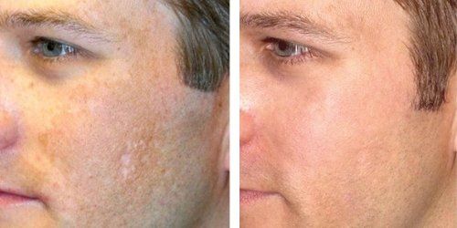 Microneedling Before and After Example #2