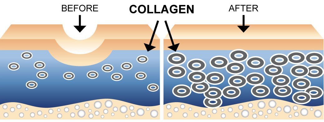 Clairderm skin microneedling results