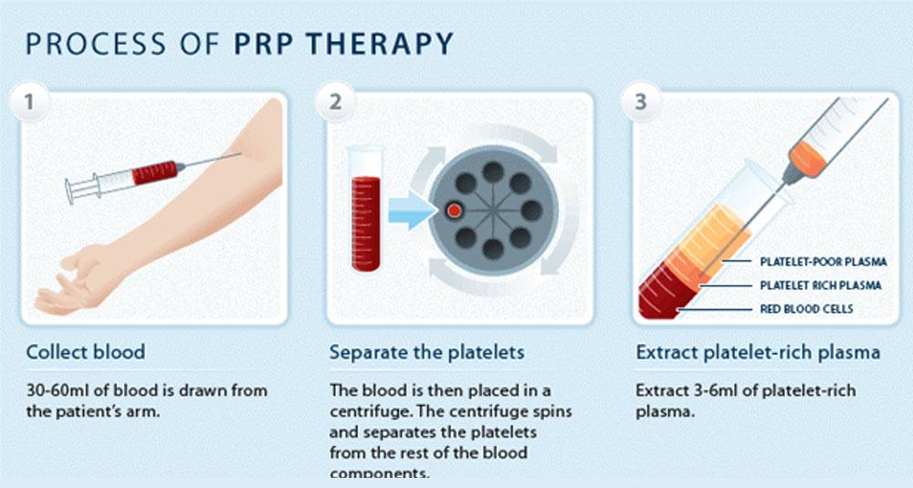 The process of PRP Therapy