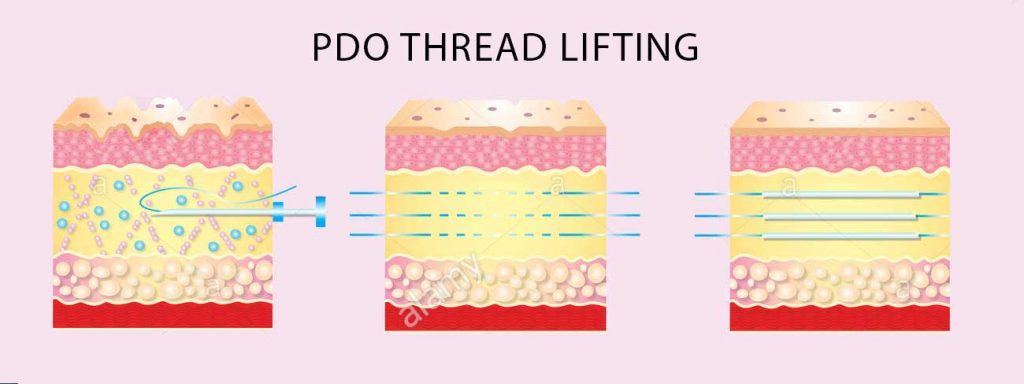 PDO Thread Lifting Infographic