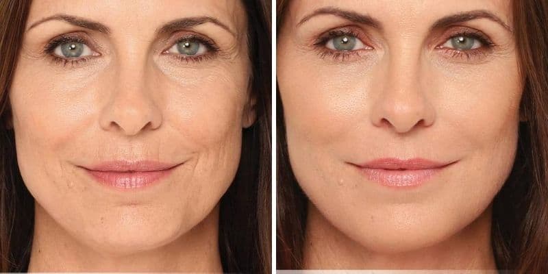 Radiesse Dermal Fillers