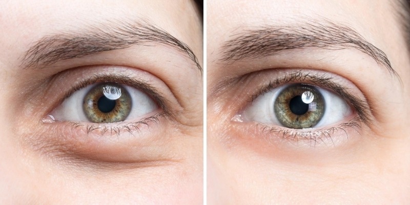 Belotero Balance for under the eyes