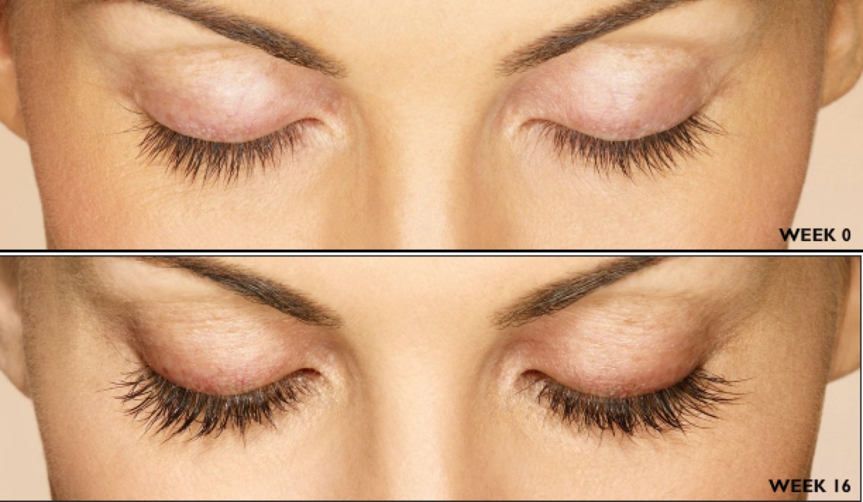 Latisse Before and After