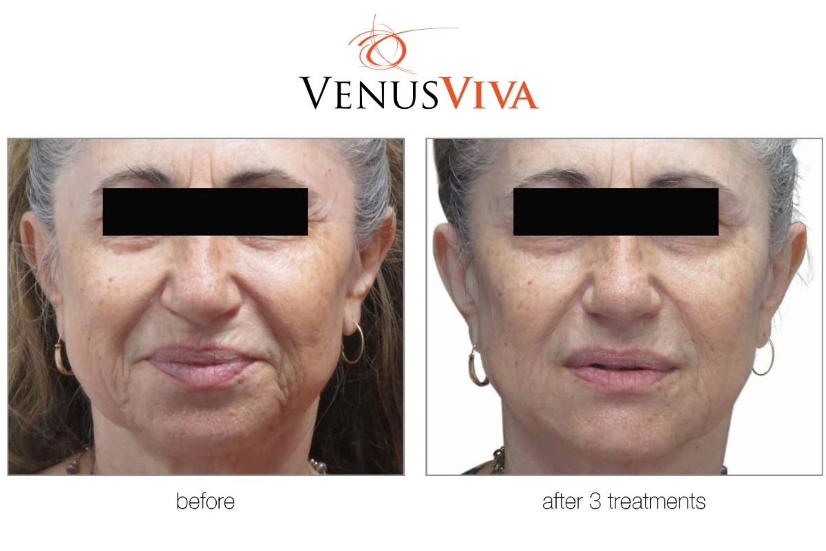 reduce wrinkles and deep lines on the face