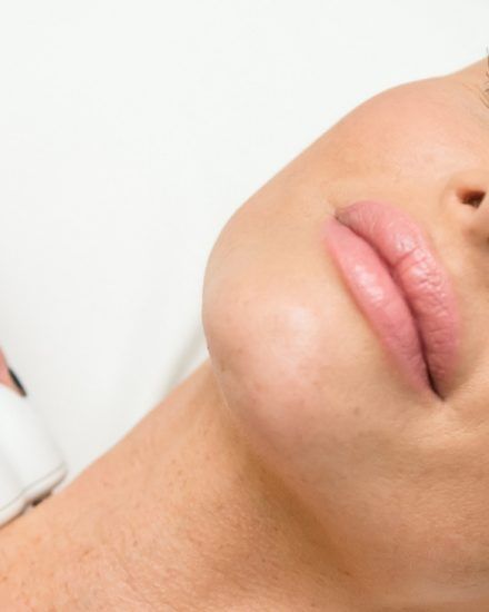 venus viva skin rejuvenation