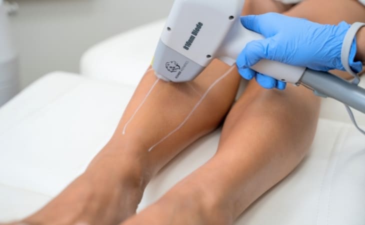 Best Laser Hair Removal Areas: How to Choose the Right Style