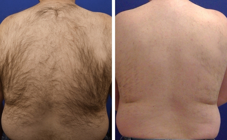 Permanent Hair Removal for Men