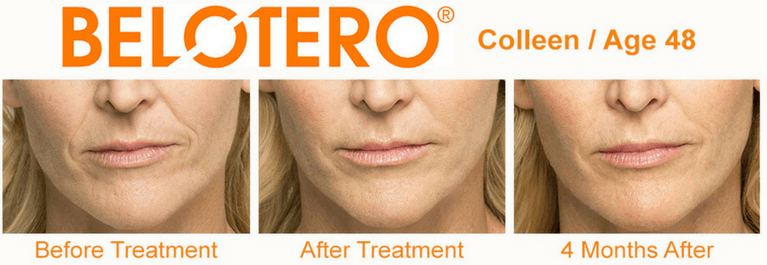 Before and After Belotero Balance Treatment