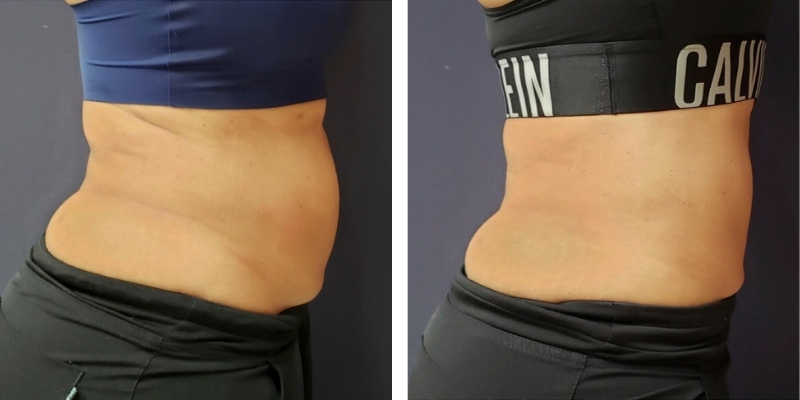 BodySculp Fat Reduction Treatment