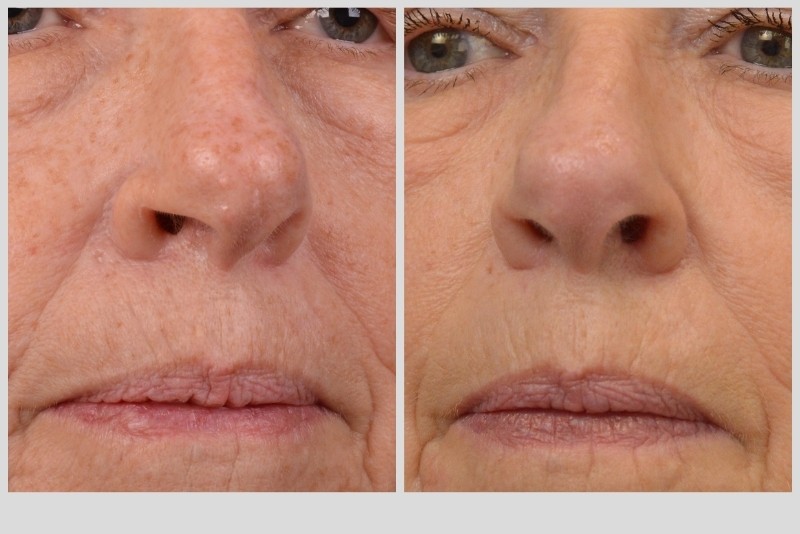 IPL Photorejuvenation Before and After