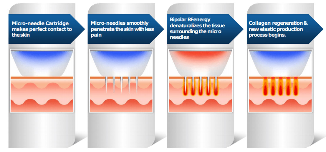 Is Microneedling Safe?