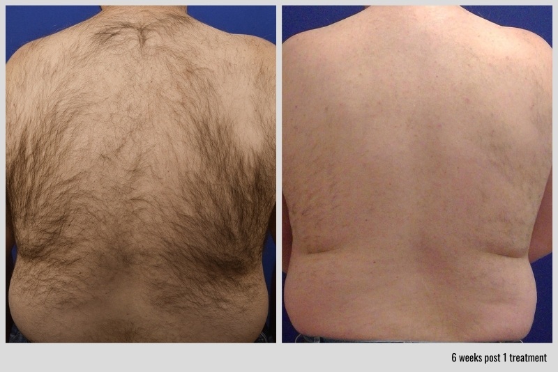 Laser hair removal before and after