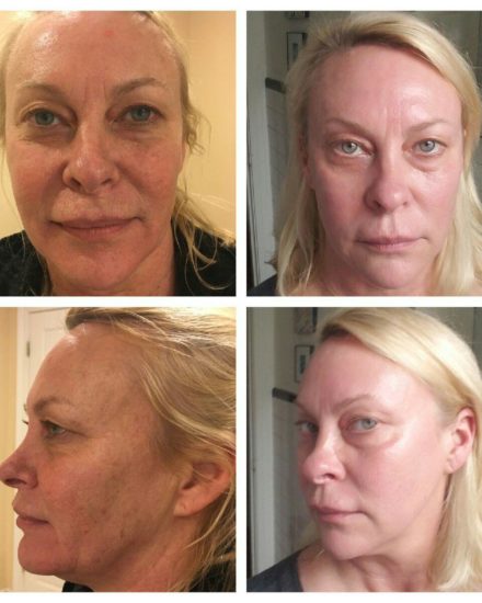 Laser skin resurfacing Before and After