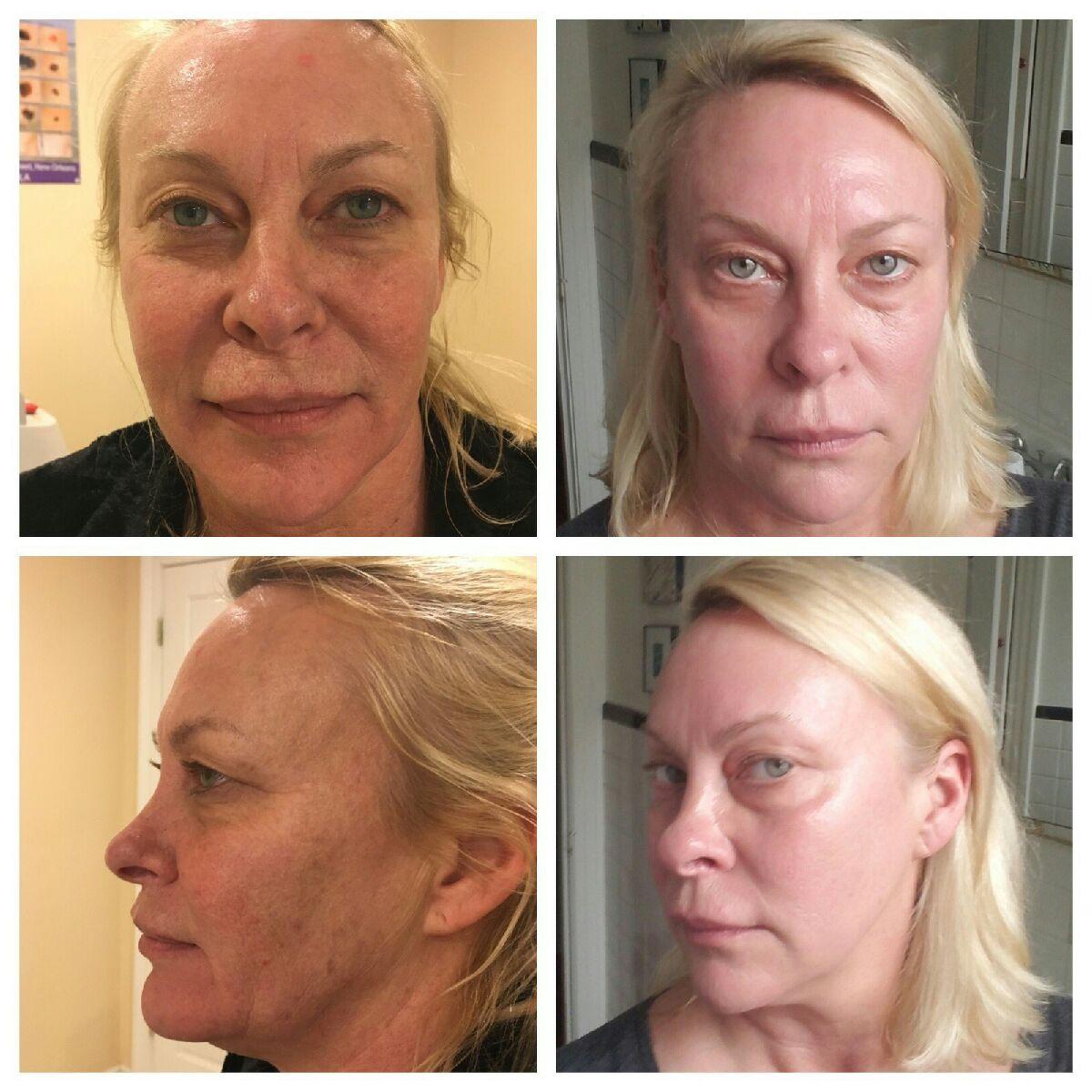 Laser skin resurfacing Before and After