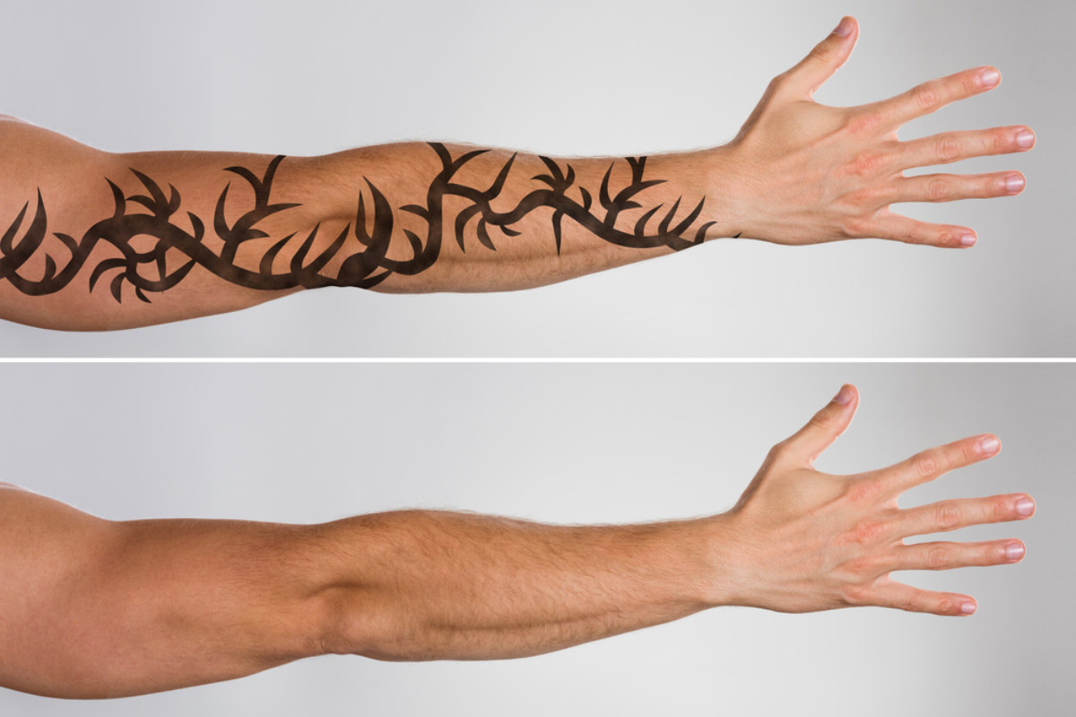 Laser tattoo removal on Maui