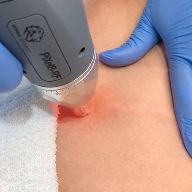 Pixel8 RF Microneedling Treatment on Maui