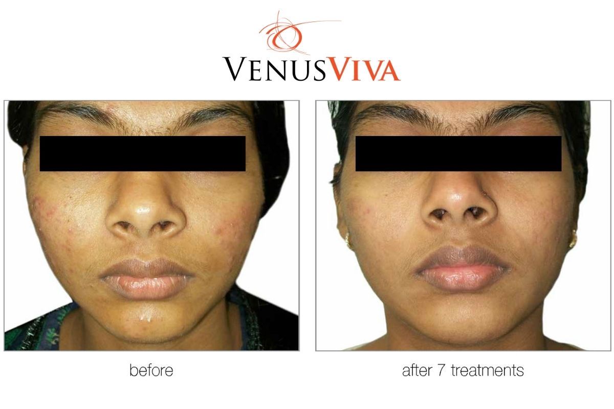 Venus Viva Before and After Photo
