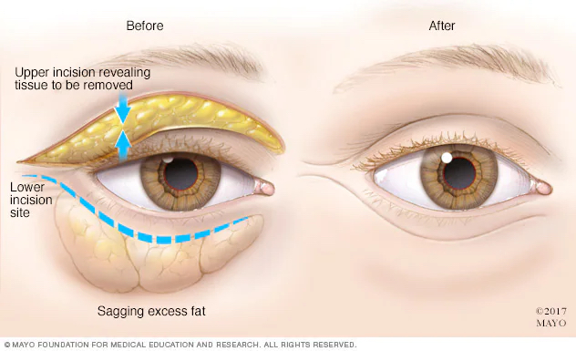 Eye Lift Without Surgery