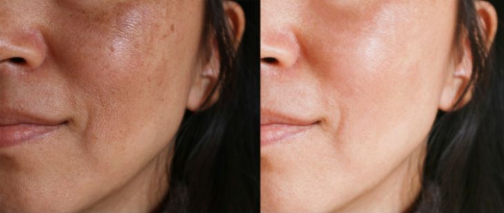Melasma Before & After Treatment