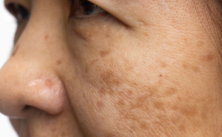 Melasma Treatment Options