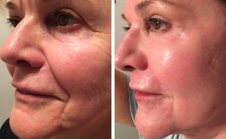 Laser Skin Resurfacing Before & After Photo