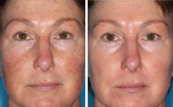 Skin Resurfacing Before & After