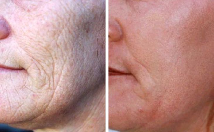 Smooth Skin From Laser Resurfacing Treatment