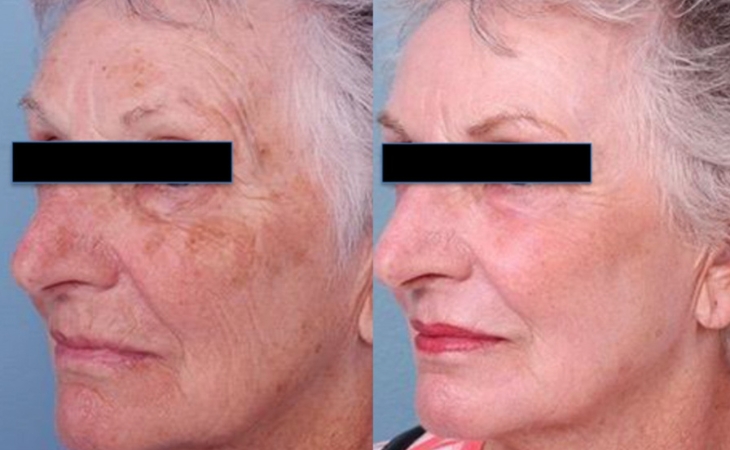 YAG Laser Skin Resurfacing