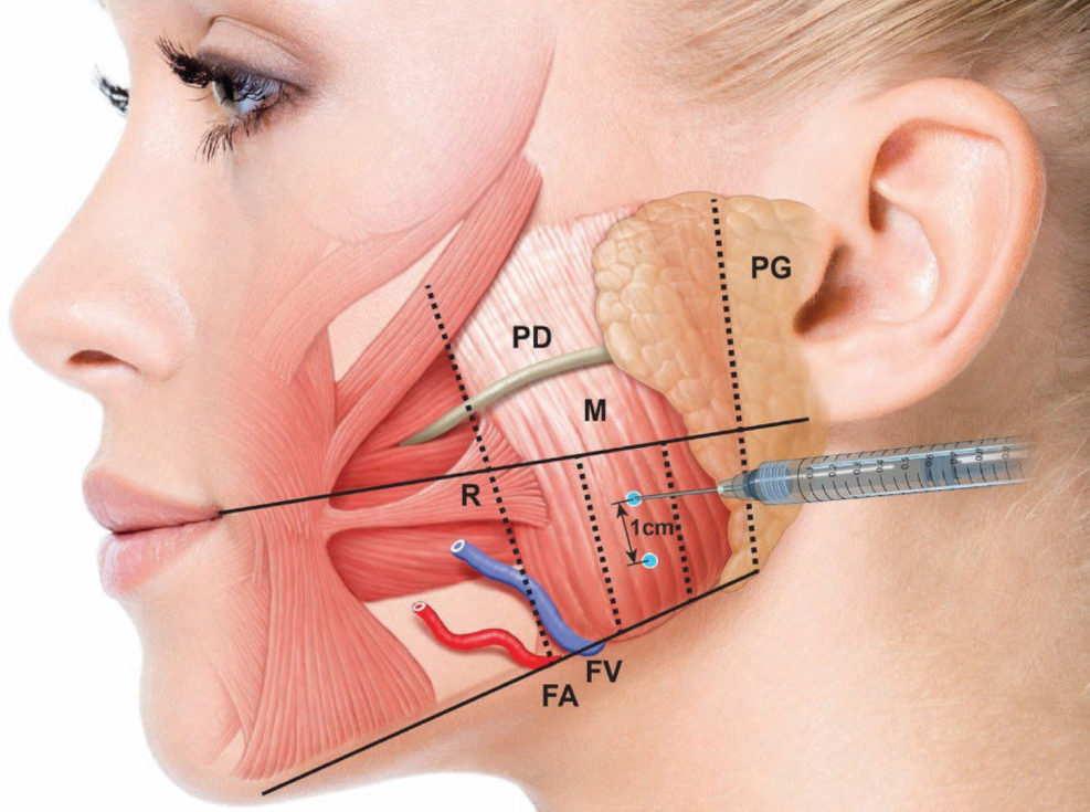 How Botox for Messeters Works