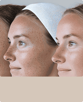 Skin<br/>Rejuvenation