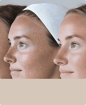 Skin<br/>Rejuvenation